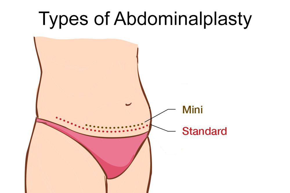 illustration of mini versus full tummy tuck